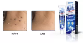 How To Use Sumifun Wart Remover: A Comprehensive Guide