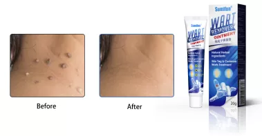 How To Use Sumifun Wart Remover: A Comprehensive Guide