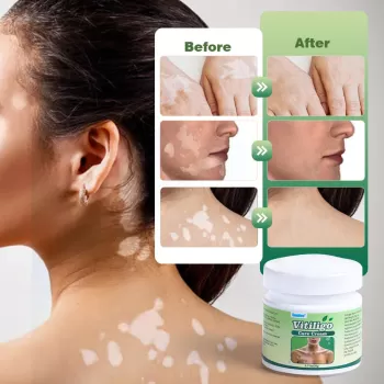 Sumifun Vitiligo Treatment Ointment
