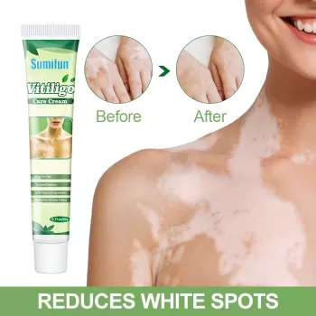 Sumifun Vitiligo Cream Sumifun Vitiligo Cream
