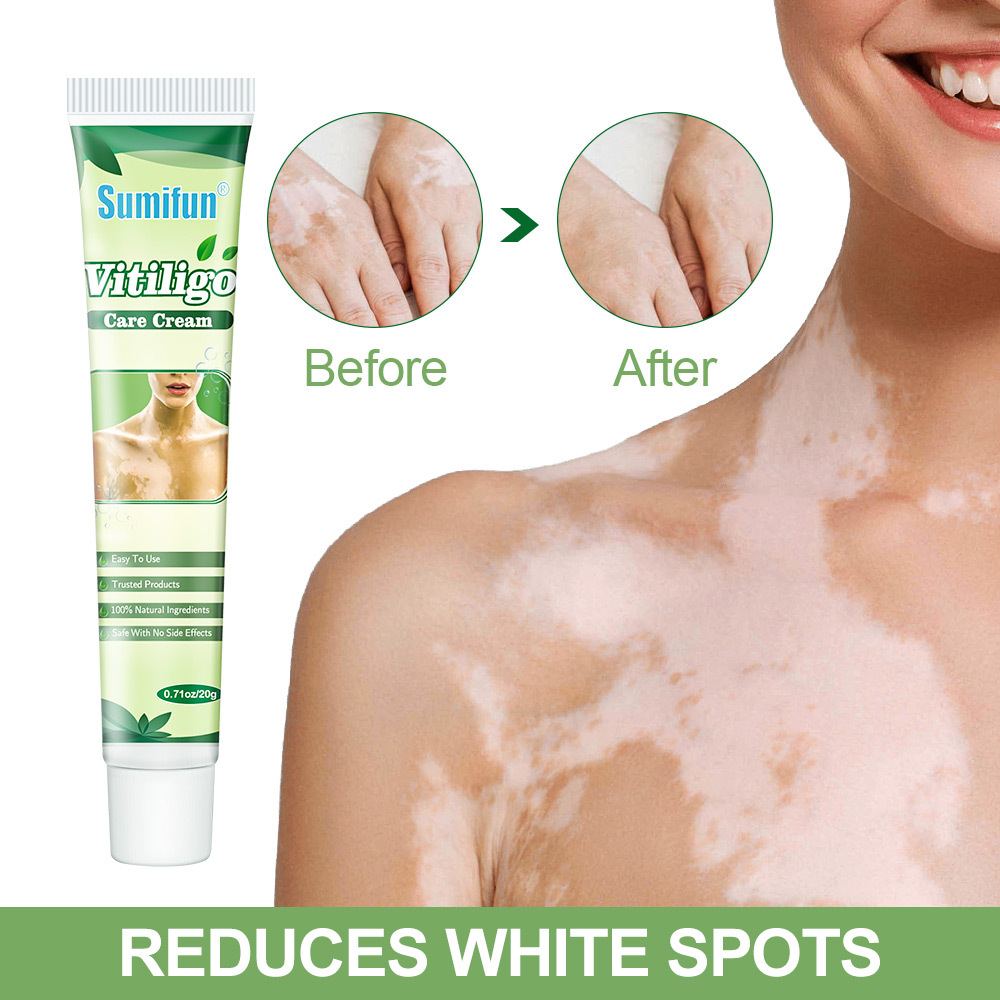 sumifun vitiligo cream introduced-3